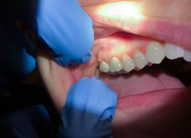 Best Emergency Wisdom Tooth Extraction in Peoria, AZ